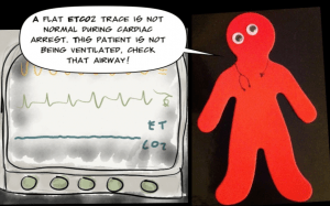 Flat trace = no ventilation (St Emlyn's Blog) 