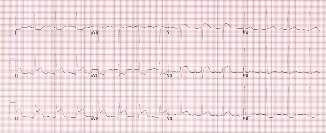 ECG 2a