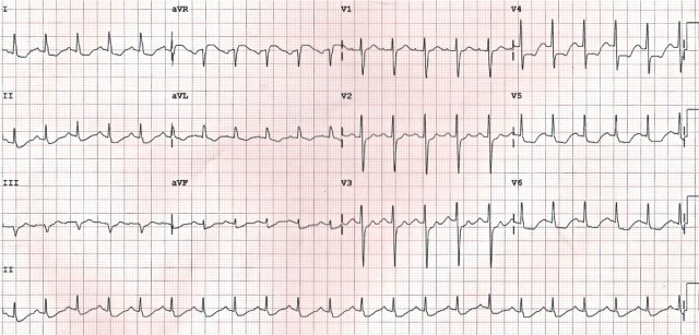 ECG 3