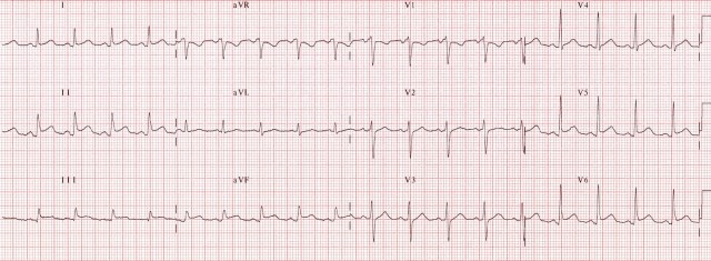 ECG 4