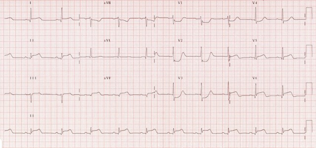 ECG 5