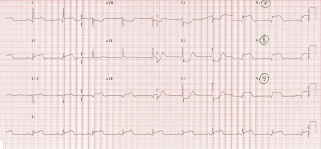 ECG 5b