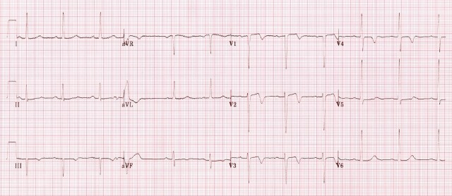 ECG 6