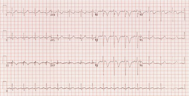 ECG 8