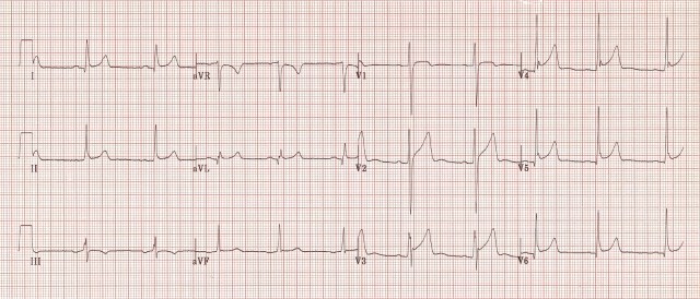 ECG 9
