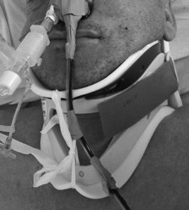 Sengstaken-Blakemore Tube Tied to a Cervical Collar
